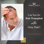 Can Grey Hair Be Transplanted?