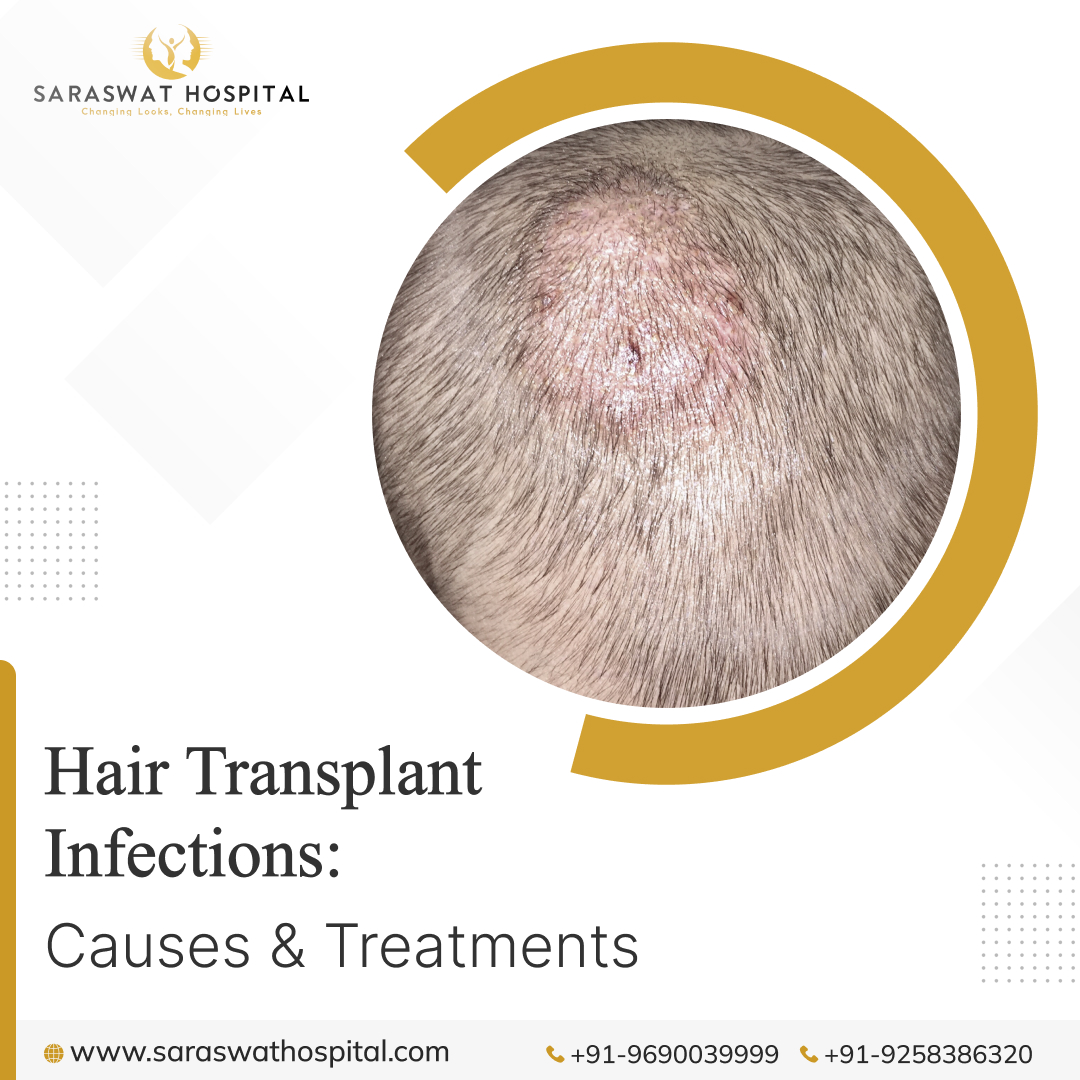 Hair Transplant Infections Causes & Treatments