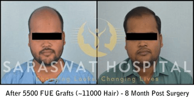 Hair Transplant Before After Results