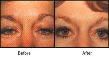 Eyelid Correction Before After Results
