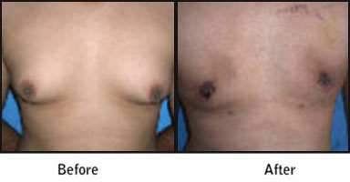 Gynecomastia Before After Results