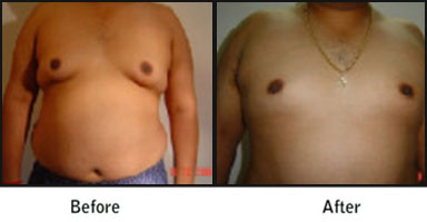 Gynecomastia Before After Results
