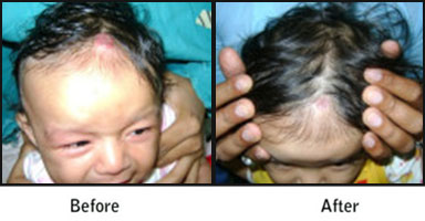 Haemangiomas Before After Results