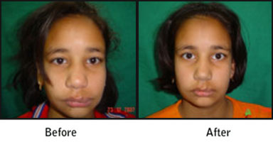 Haemangiomas Before After Results