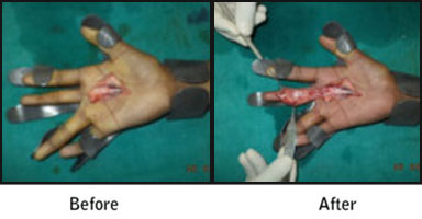 Hand Surgery Before After Results