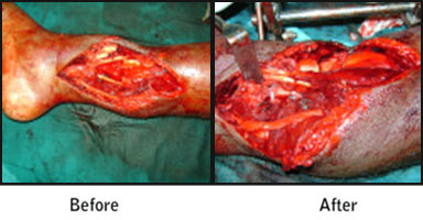 Micro Vascular Surgery Before After Results