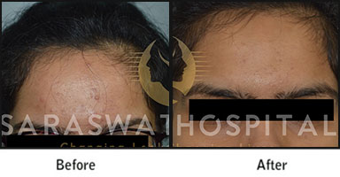 Acne Scars Before After Results