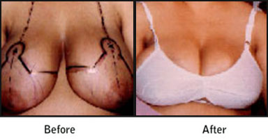 Breast Reduction Before After Results