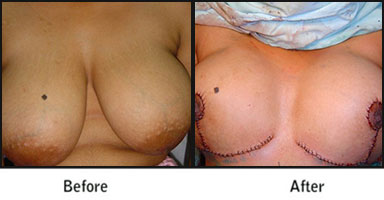 Breast Reduction Before After Results