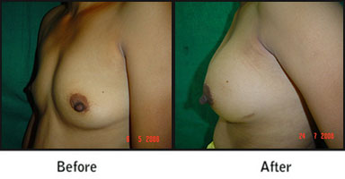 Breast Implant Before After Results