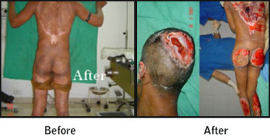 Burns & Contractures Before After Results
