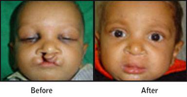 Cleft, Lip, & Palate Before After Results