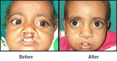 Cleft, Lip, & Palate Before After Results