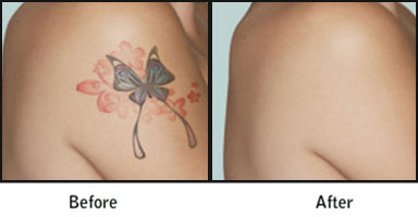 Laser Tattoo Removal Before After Results