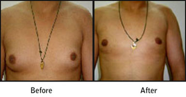 Liposuction Before After Results