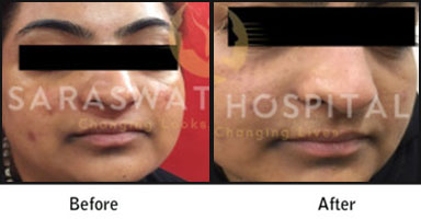 Chemical Peels Before After Results