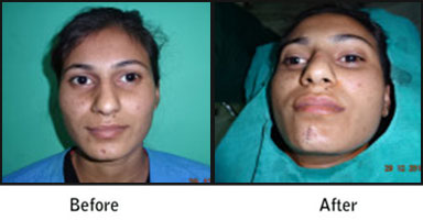 Scar Surgery Before After Results
