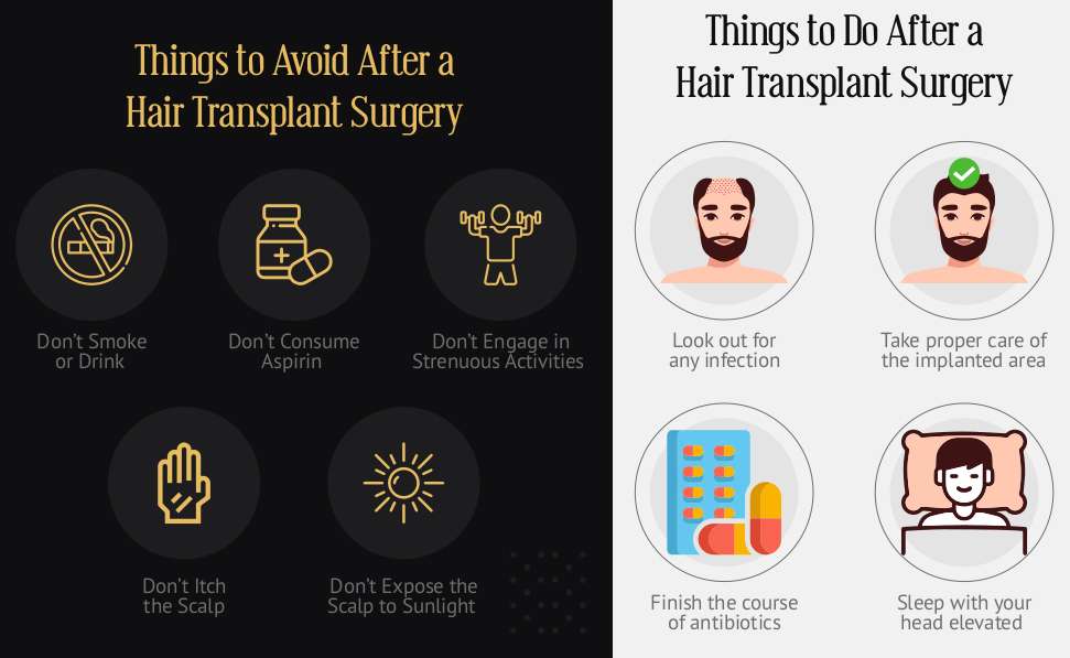 Things to do after hair transplant surgery