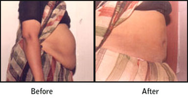 Tummy Tuck Before After Results