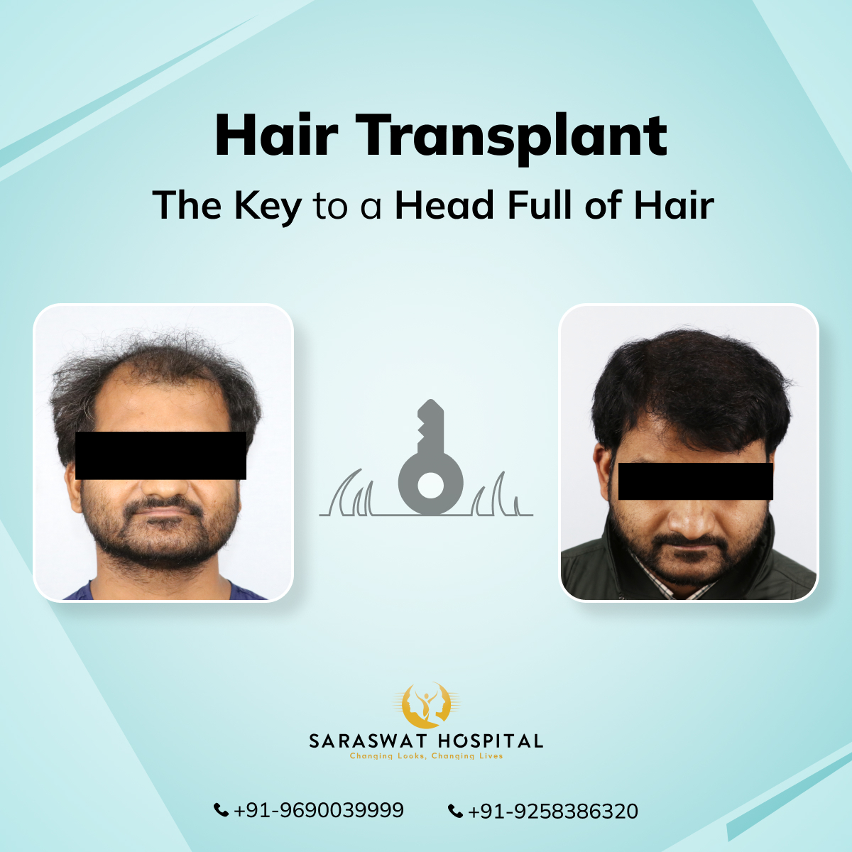 Hair Transplant- The Key to a Full Head of Hair