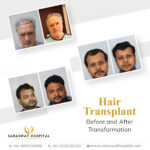FUE Hair Transplant Before and After Results