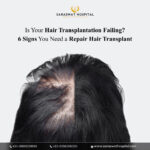 6 Signs You Need a Repair Hair Transplant