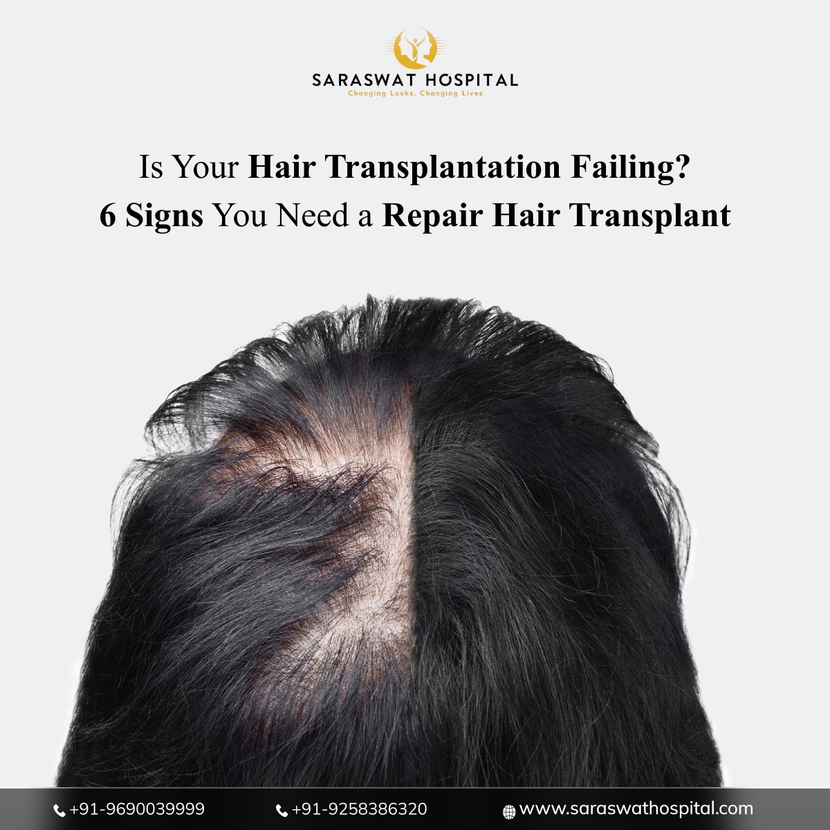 6 Signs You Need a Repair Hair Transplant