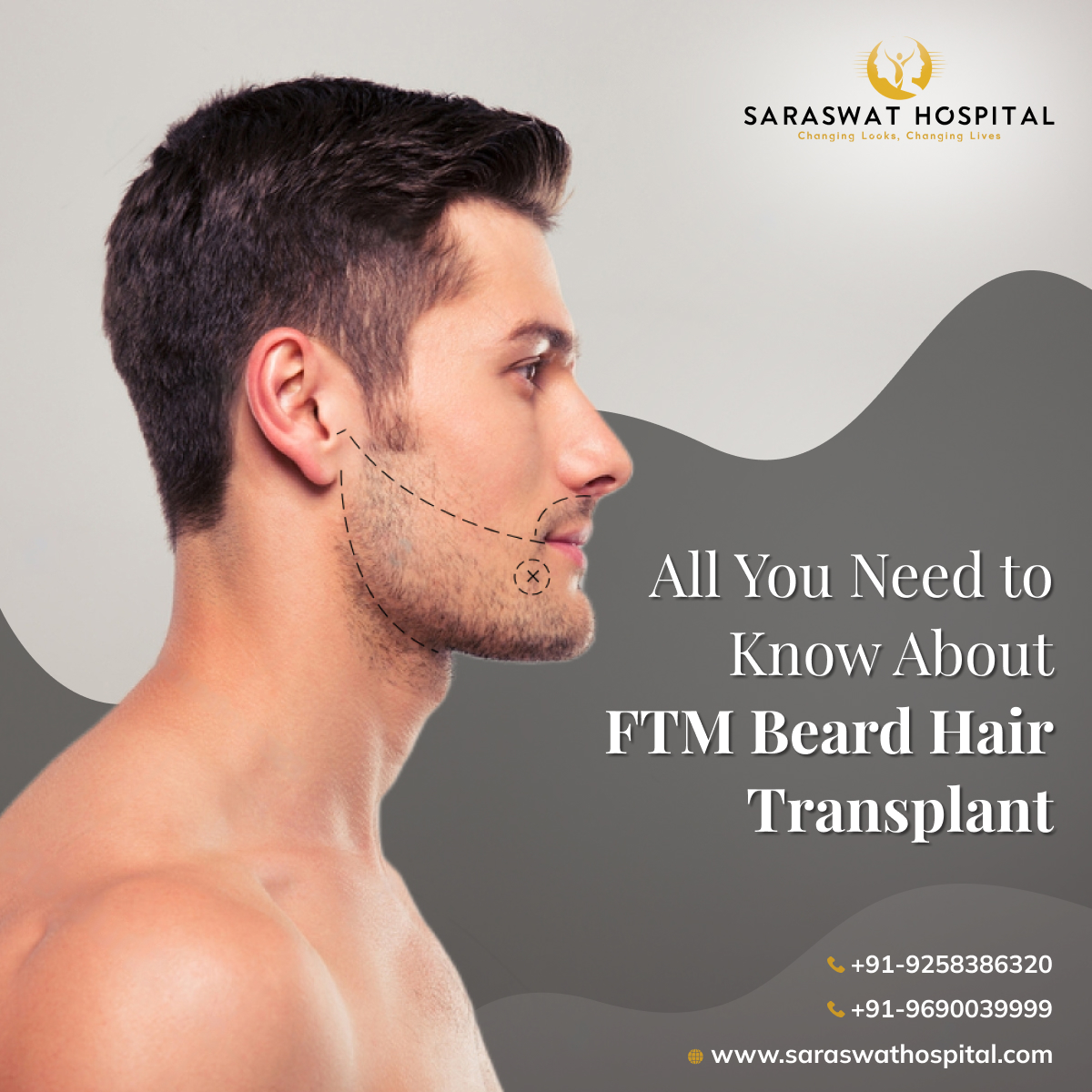 FTM Beard Hair Transplant