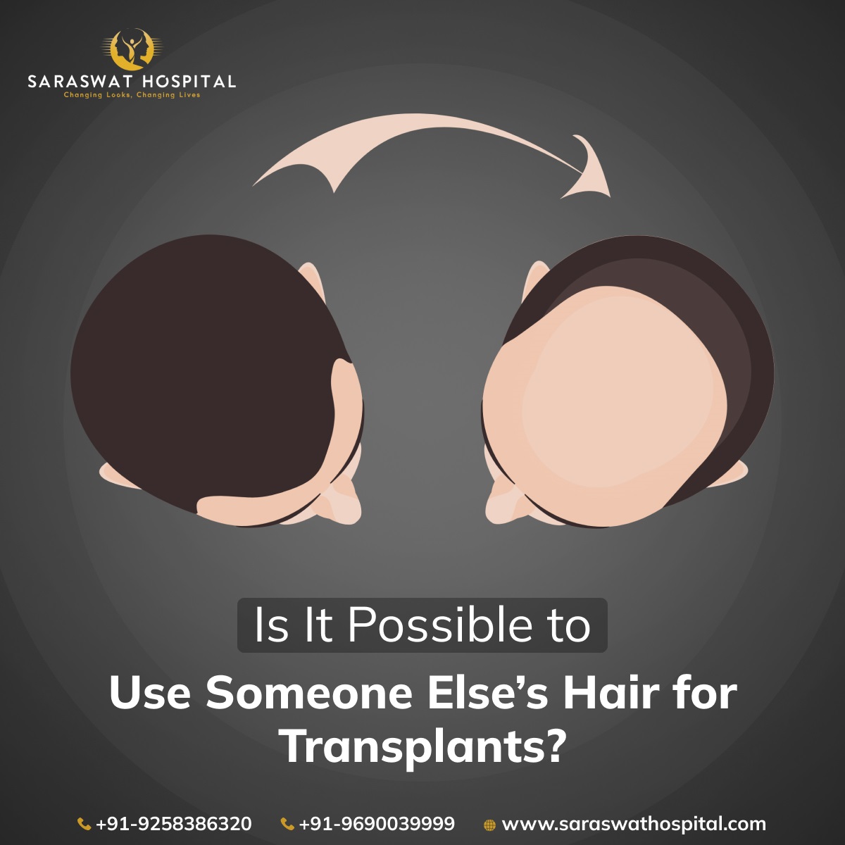 Is it possible to use someone else's hair for transplant