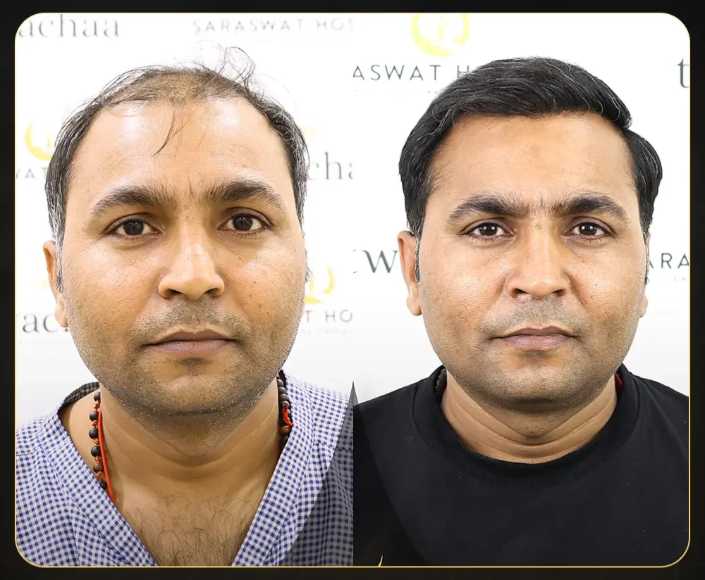 Hair Transplant Before and After results by Saraswat Hospital