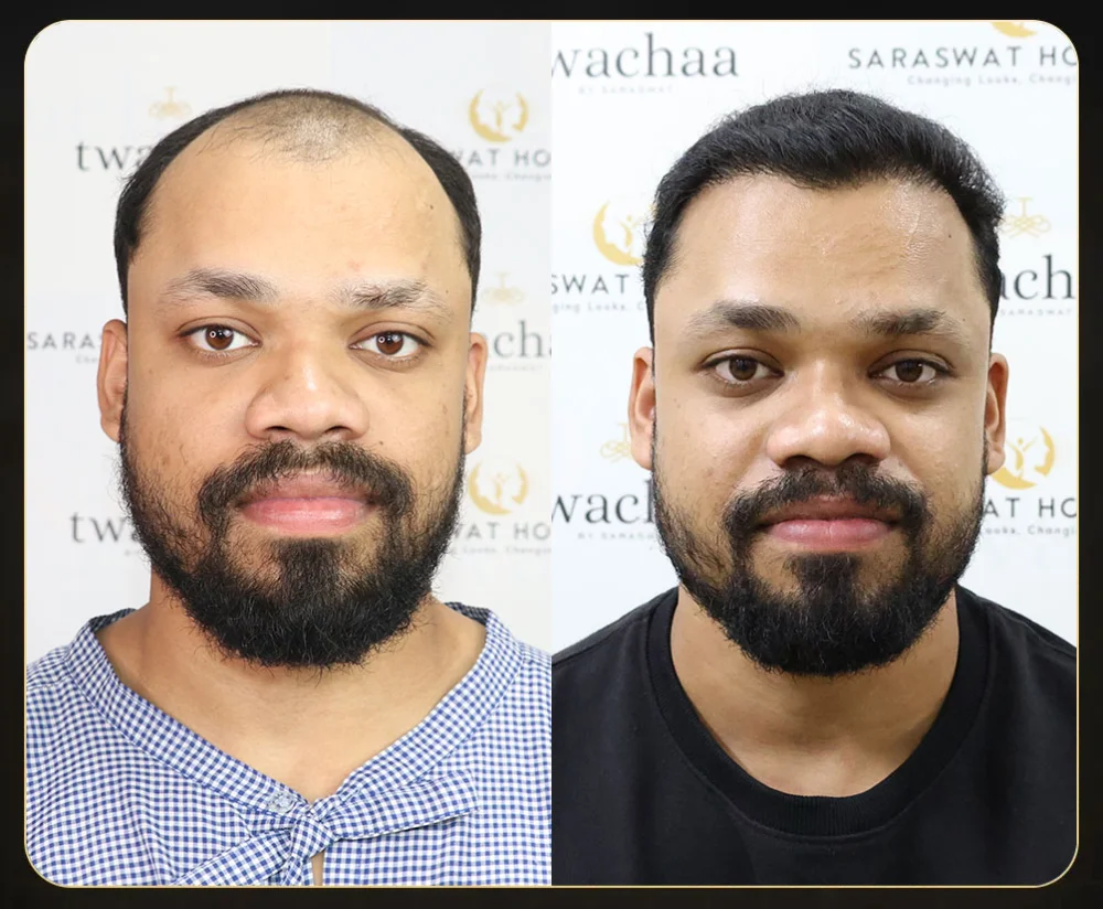 Hair Transplant Before and After results by Saraswat Hospital