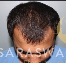 Hair Transplant - Saraswat Hospital