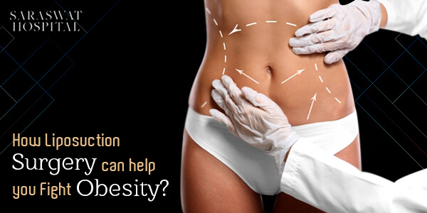 liposuction surgery in India