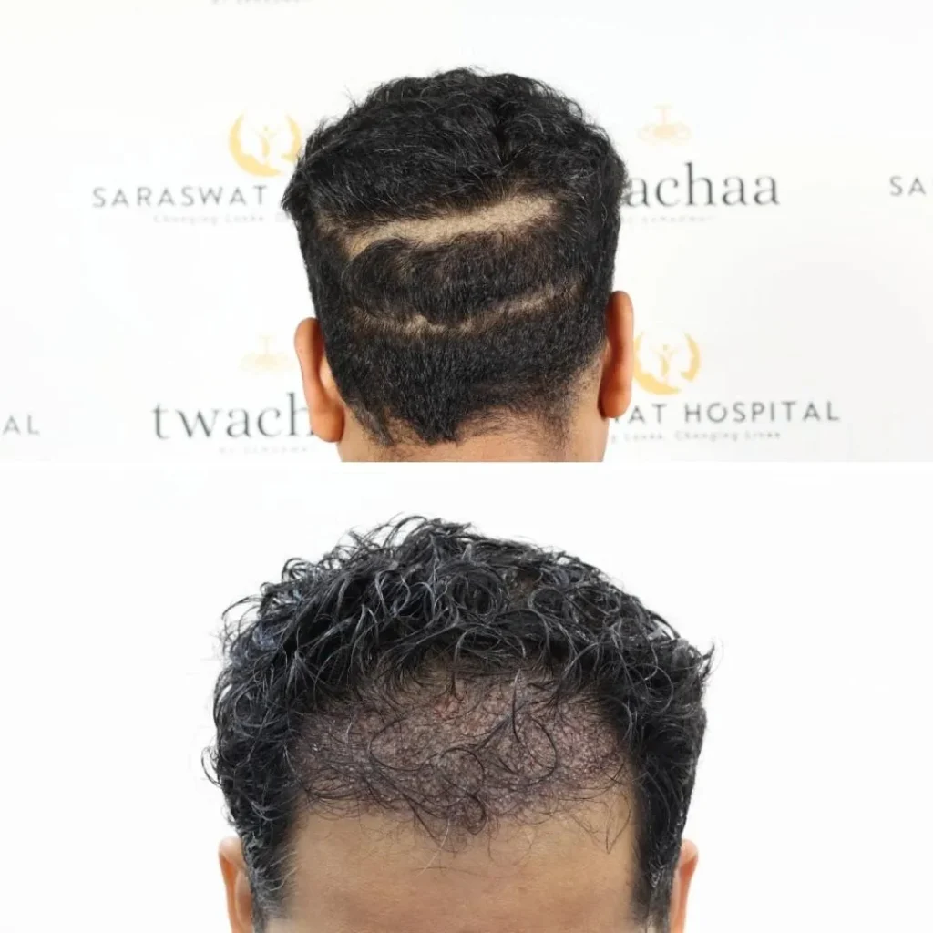 Non-Shaven Hair Transplant