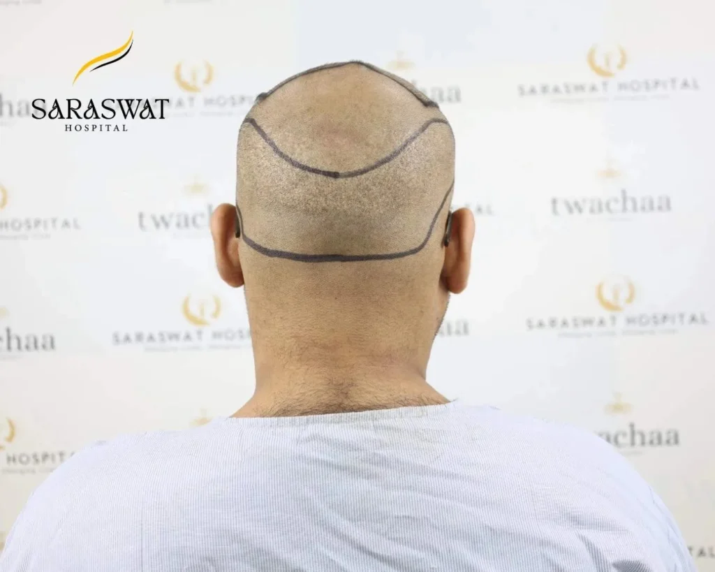 Follicular Unit Extraction Scar