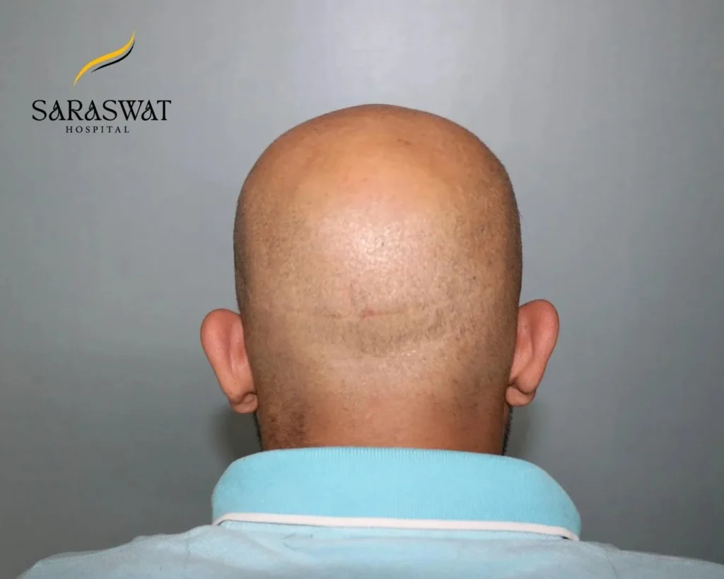 Follicular Unit Transplantation Scar