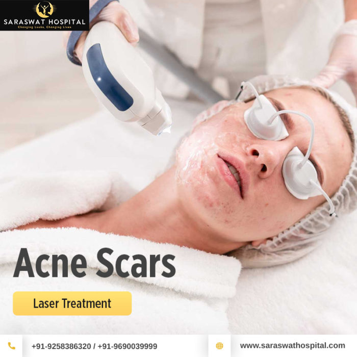 acne scar treatment
