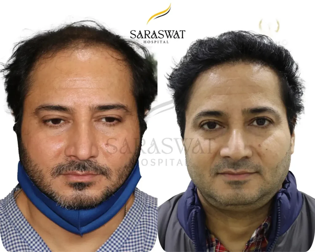 FUE Hair Transplant Result
