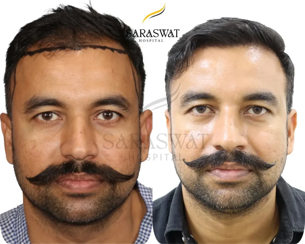 Hair Transplant Before and After