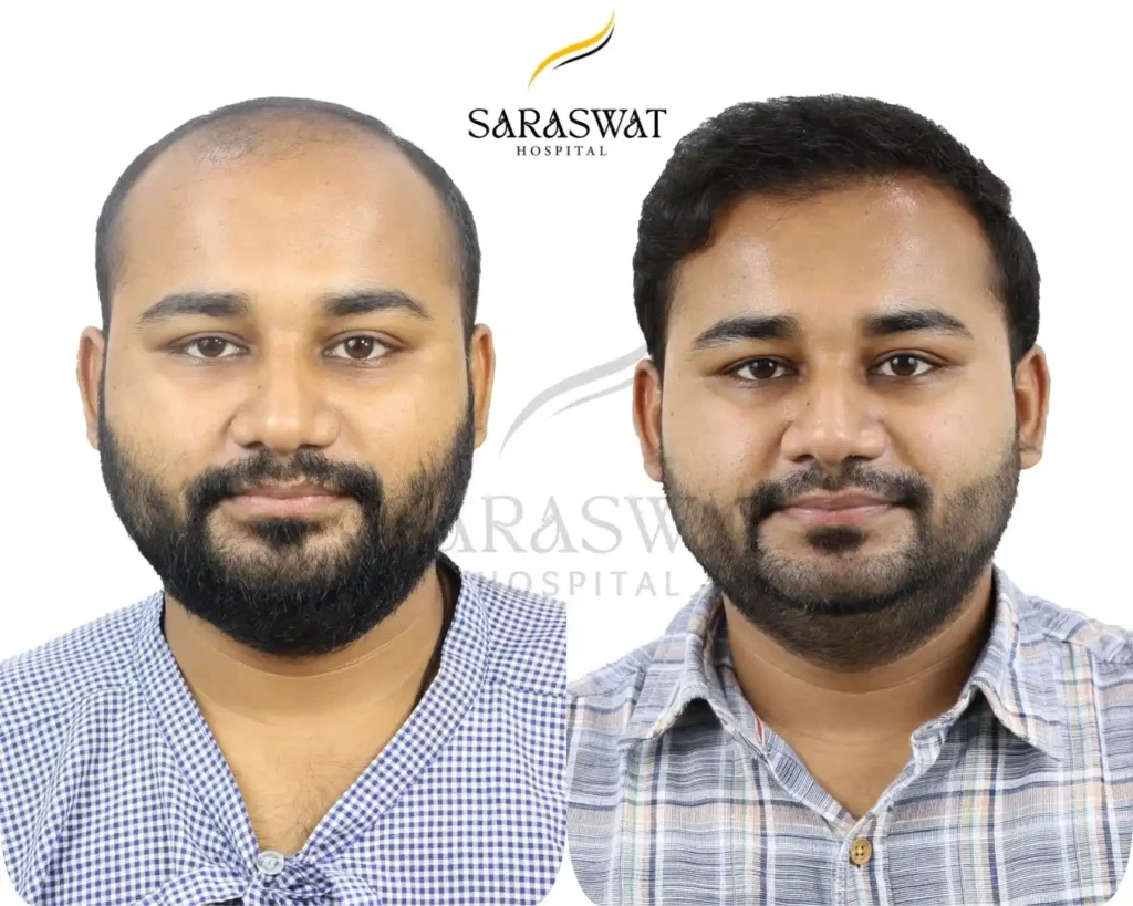 Hair Transplant Before and After Result
