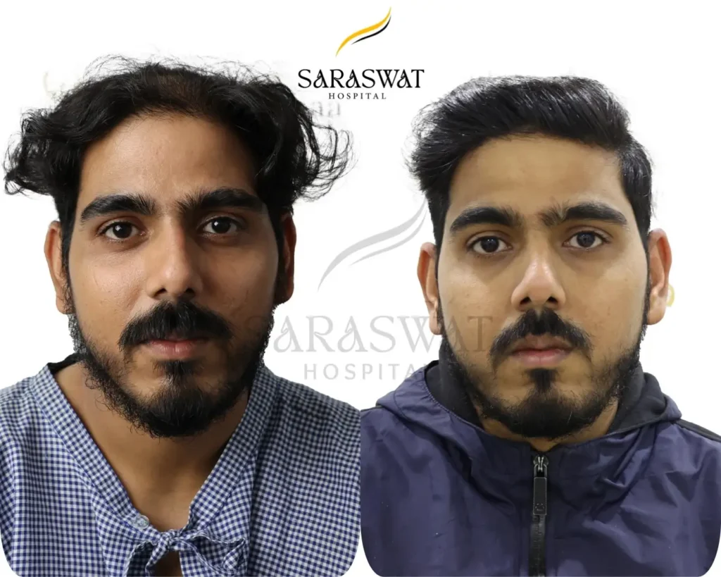 Hair Transplant Result