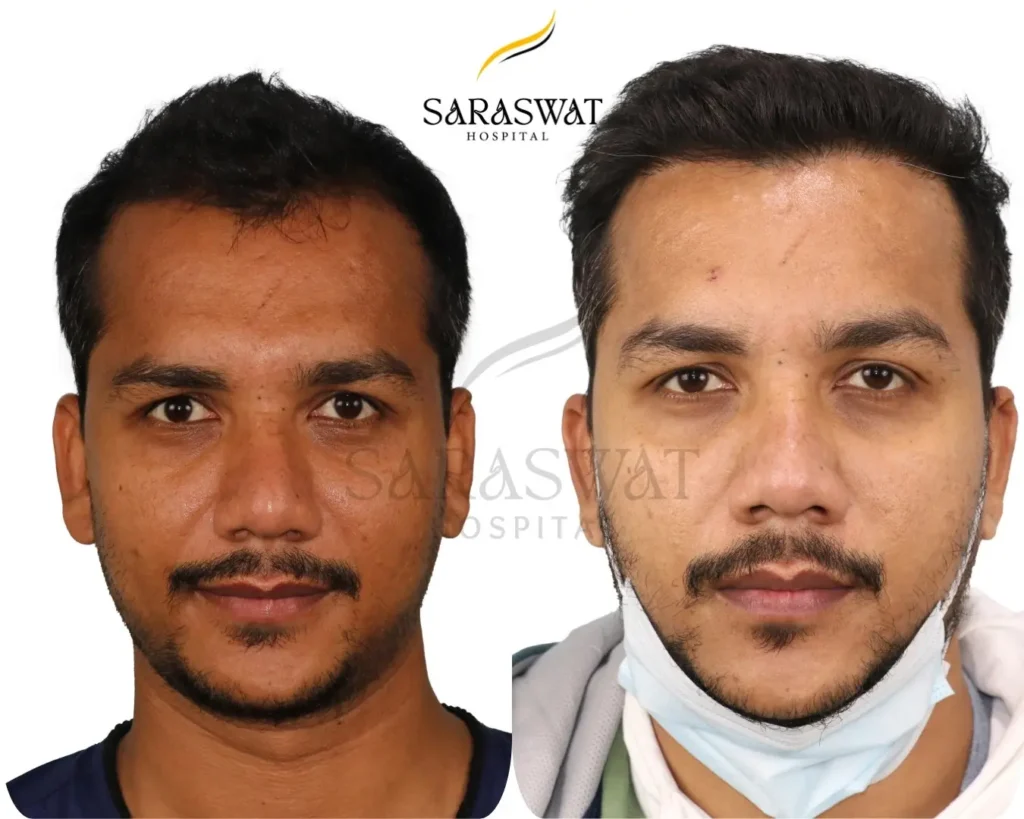 Hair Transplant Result