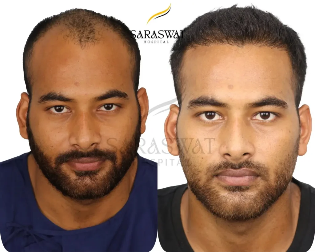 Hair Transplant Before and After Result