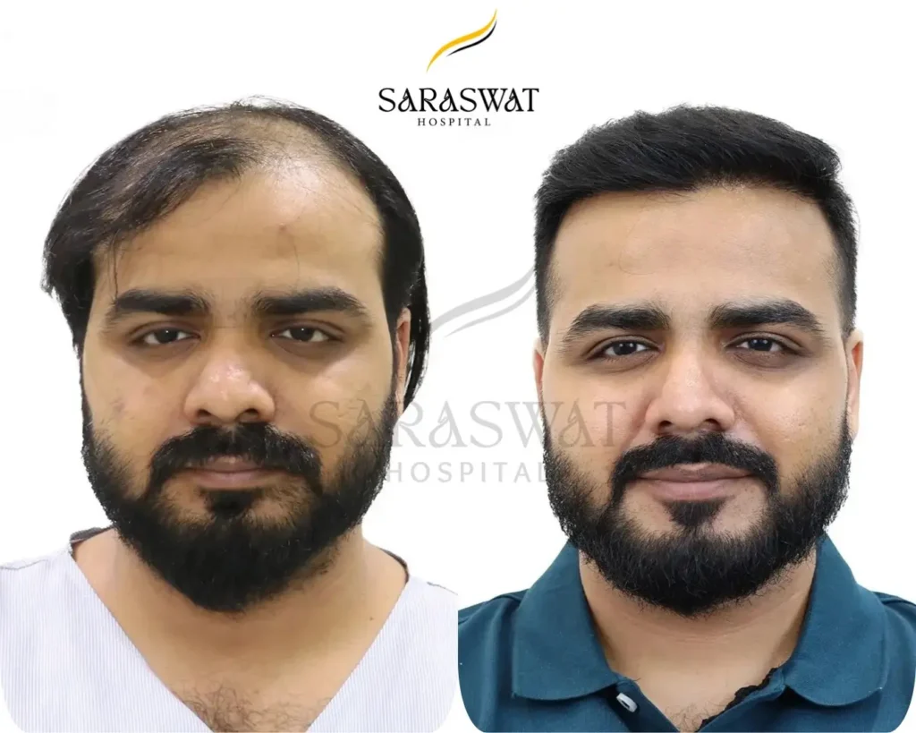Hair Transplant Result After 9 Months