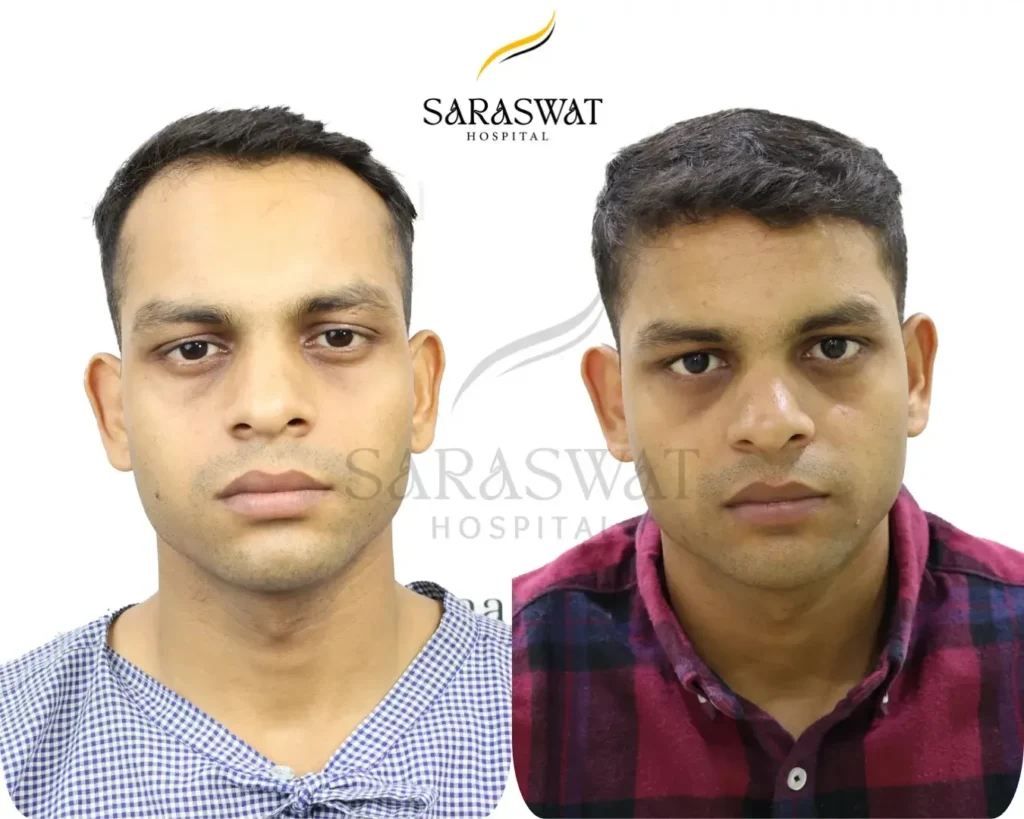 FUE Hair Transplant Result