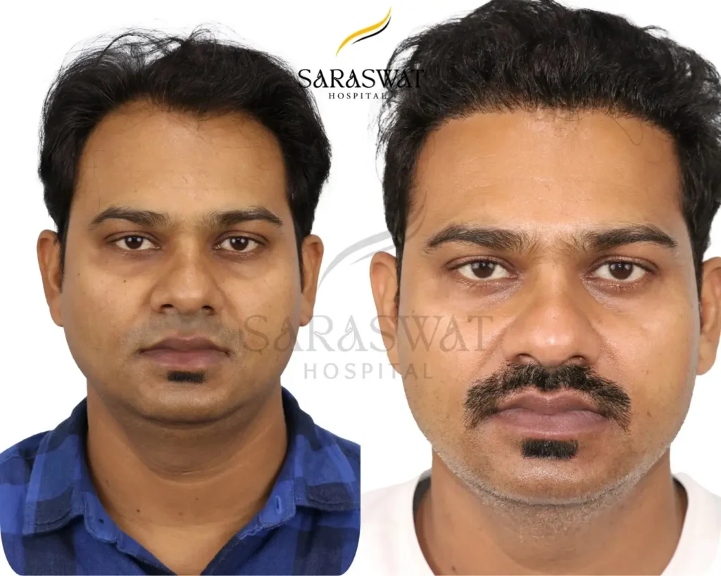 Hair Transplant Before and After Result