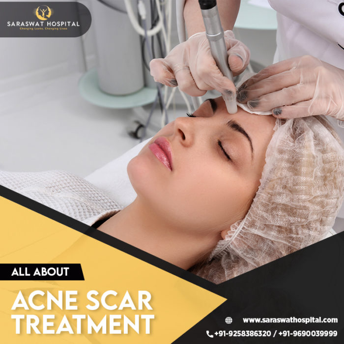 acne scar treatment