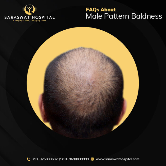 Male Pattern Baldness FAQ's