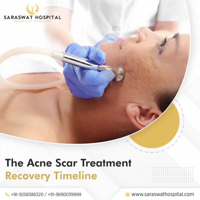 Acne Scar Treatment Recovery Timeline