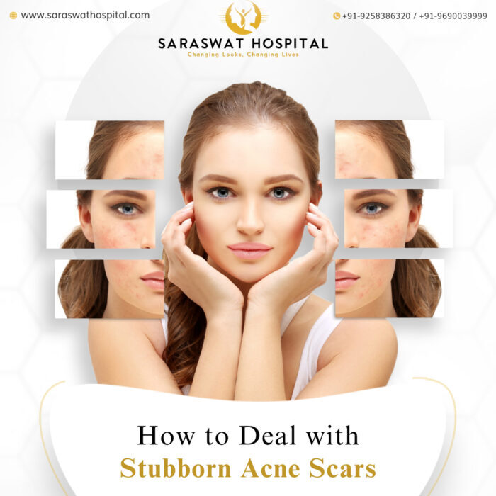 What Is the Most Effective Solution to Acne Scars?